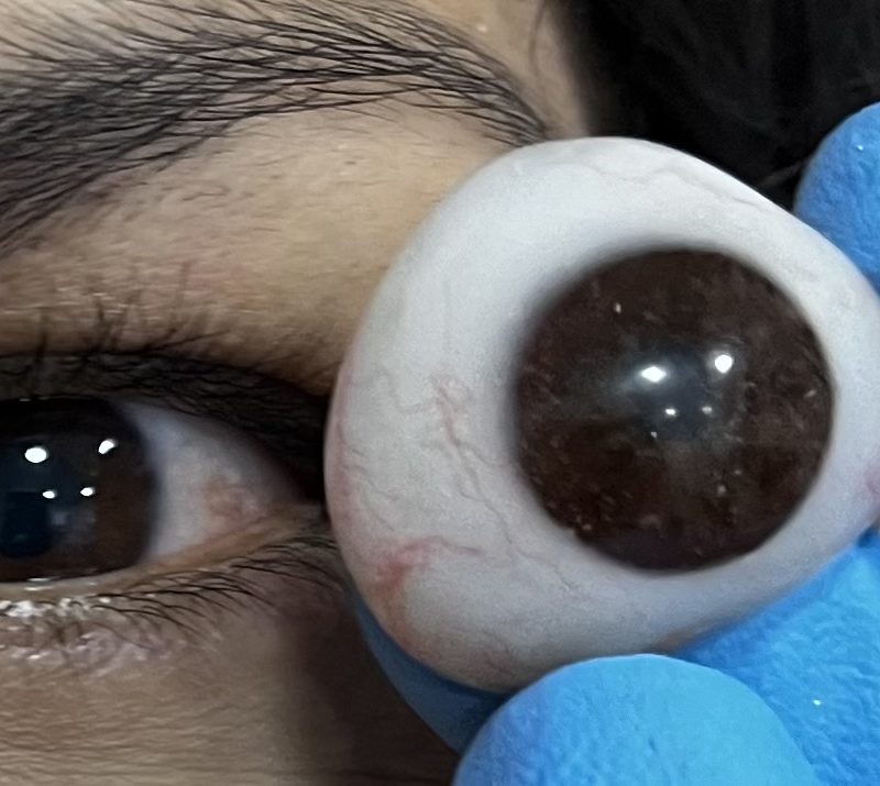 FABRICACIÓN Y ADAPTACIÓN DE PRÓTESIS OCULAR